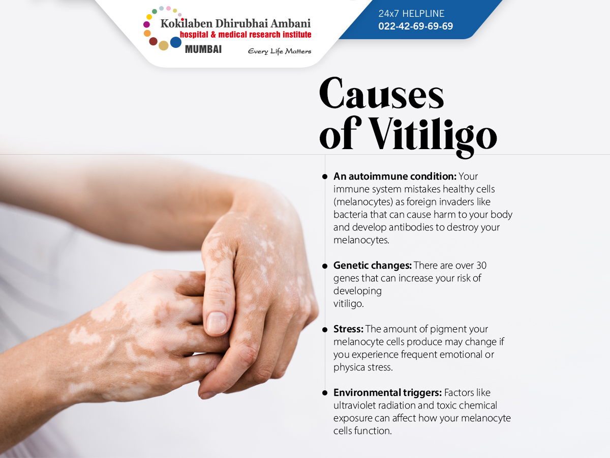 KDAHMumbai's tweet photo. Treatment options for #vitiligo are available to help manage the symptoms. If you suspect you have vitiligo or notice any #skinchanges, consult a #dermatologist for an accurate diagnosis and appropriate treatment options. #WorldVitiligoDay https://t.co/IewiDHbyj9