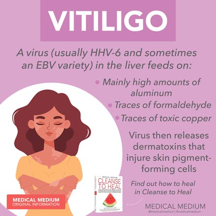 Vitiligo is a viral condition—not a genetic condition or the body attacking itself. Learn more: medicalmedium.com/blog/vitiligo