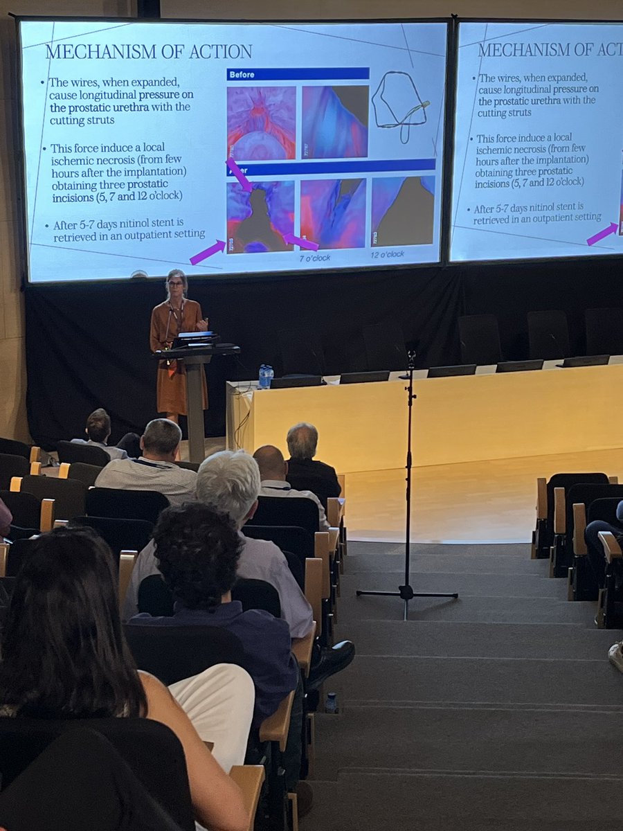 Nathan Hooker (@nathanhooker12) on Twitter photo <a href="/hospitalclinic/">Hospital Clínic</a> <a href="/AntonioAlcarazA/">Antonio Alcaraz</a> <a href="/albertobudiaalb/">alberto budia alba</a> @ranjithramamd Day 2: <a href="/albertobudiaalb/">alberto budia alba</a> & Dr. Secco, experts in #MIST applications, gives us an excellent overview of the current landscape of offerings, with #iTind getting lots of attention! It’s truly Reshaping BPH Treatment! #BPH <a href="/hospitalclinic/">Hospital Clínic</a> <a href="/AntonioAlcarazA/">Antonio Alcaraz</a> <a href="/albertobudiaalb/">alberto budia alba</a> @ranjithramamd Day 2: <a href="/albertobudiaalb/">alberto budia alba</a> & Dr. Secco, experts in #MIST applications, gives us an excellent overview of the current landscape of offerings, with #iTind getting lots of attention! It’s truly Reshaping BPH Treatment! #BPH