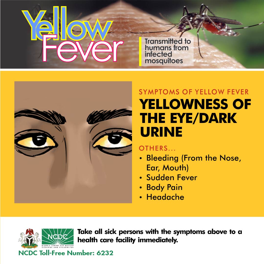 A suspected case of #YellowFever is any person with sudden fever, vomiting, serious back pain,  with yellowness of the eye and skin appearing within 14 days.

Take all sick persons to a healthcare facility immediately for accurate diagnosis and treatment.

#YellowFeverInfo