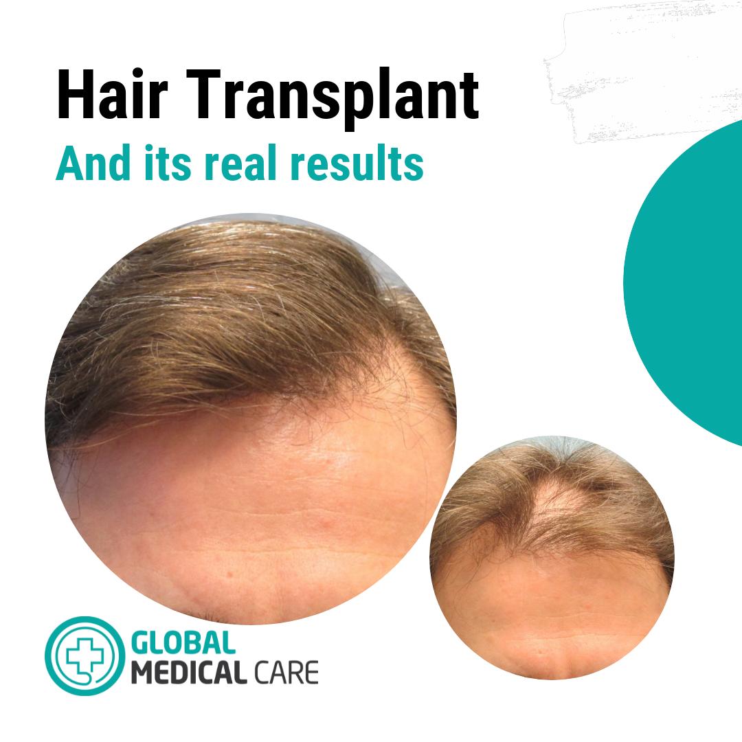 Our patient was operated on by experienced doctors using 4in1 method to ensure fast recovery and natural results. #hairtransplant #hairtransplantation #hairtransplantistanbul #hairtransplantturkey #besthairtransplant