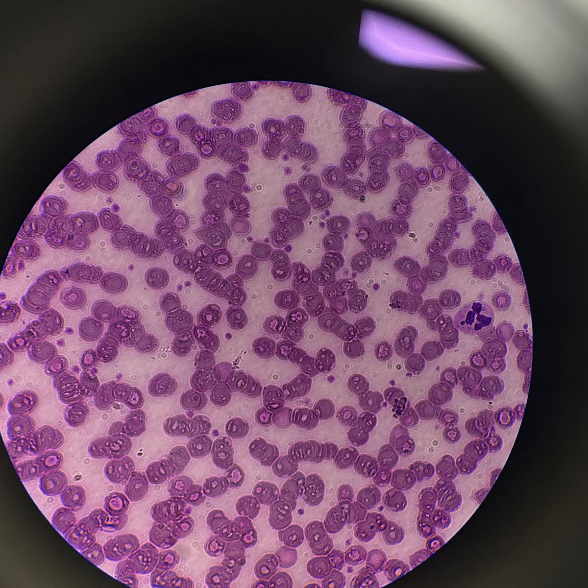 25/Female

This is her blood smear under Oil Immersion (100x magnification)

Neutrophil segmenter at the right side of the field

Normocytic, normochromic red blood cells. Platelets mildly increased.