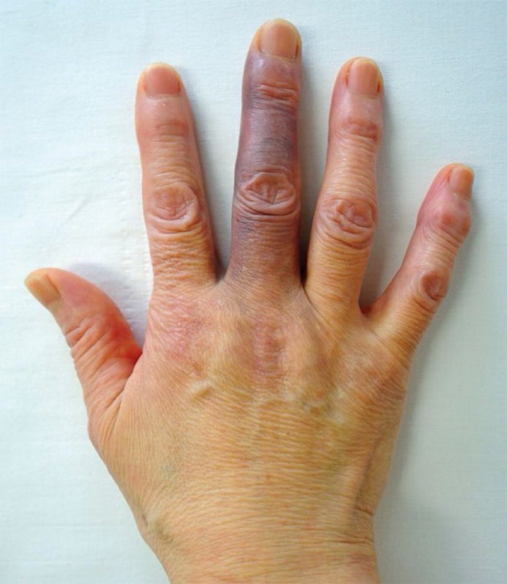 BrownJHM's tweet photo. A healthy 66-year-old nonsmoking woman presented with recurrent pain and bruising in her right middle finger. She denied trauma or exposure to cold, and had normal complete blood count and coagulation studies. What is the likely diagnosis? #Medtwitter #RheumTwitter https://t.co/4DClOdTpTV