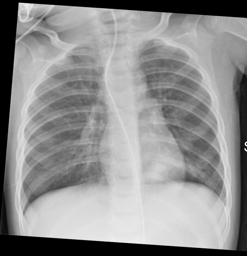 Andrew Dixon (@drandrewdixon) on Twitter photo Coming up next hour! Join <a href="/DrJohnAdu/">John Adu</a> for a paediatric chest imaging lecture as part of the #Radiopaedia2023 free Friday Livestreams. #foamrad 
youtube.com/radiologychannโฆ Coming up next hour! Join <a href="/DrJohnAdu/">John Adu</a> for a paediatric chest imaging lecture as part of the #Radiopaedia2023 free Friday Livestreams. #foamrad 
youtube.com/radiologychannโฆ