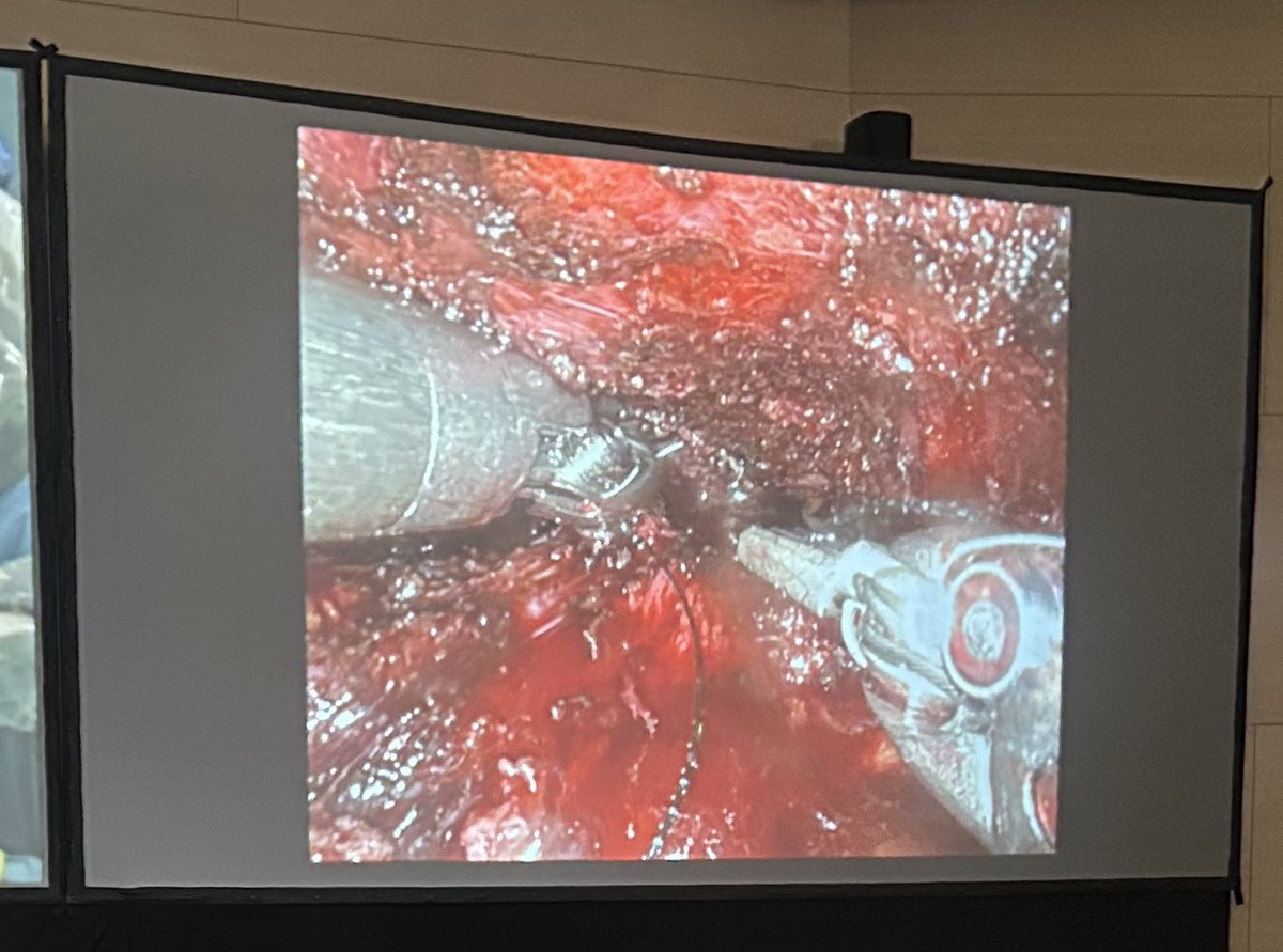 Juan M López-Martínez (@urodrlopez) on Twitter photo Robotic Re-do anastomosis. Excellent surgery for challenging case by DrPeri & <a href="/AntonioAlcarazA/">Antonio Alcaraz</a> #UroForum2023 Robotic Re-do anastomosis. Excellent surgery for challenging case by DrPeri & <a href="/AntonioAlcarazA/">Antonio Alcaraz</a> #UroForum2023