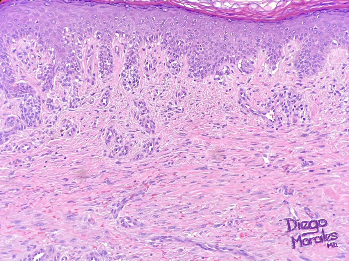 PRAME expression in myofibroblasts of a scar in an excision of melanocytic lesion, a potential pitfall. Reported last year for the 1st time in this letter to the editor pubmed.ncbi.nlm.nih.gov/35103337/, and this case is a first for me. #PathTwitter #dermpath #ihcpath