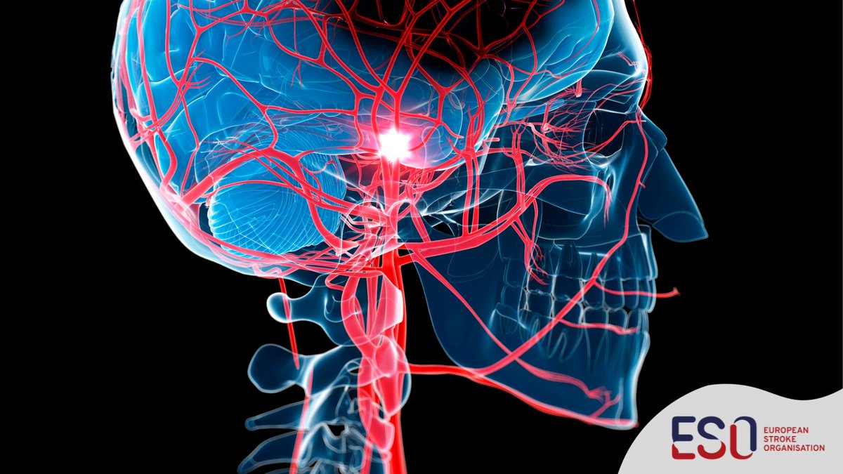In our #ESOblog <a href="/gerritgrosse/">Gerrit M. Große</a> from @MHH_life gives insight into starting anticoagulation following cardioembolic stroke  in the &amp; ELAN trial, which was presented at #ESOC2023.

Read more about this landmark trial: ow.ly/M0pL50OUEqL

#stroke #strokeresearch <a href="/FishingNeurons/">Urs Martin Fischer</a>