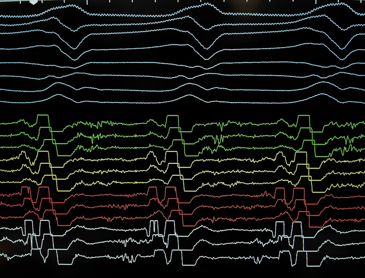 Josef Kautzner (@josefkautzner) on Twitter photo Thanks to a support by Abbott, we performed for Together VT with Jana Haskova a nice VT case after myocardial infarction with shared isthmus for 2 morphologies of VT. Thanks to a support by Abbott, we performed for Together VT with Jana Haskova a nice VT case after myocardial infarction with shared isthmus for 2 morphologies of VT.