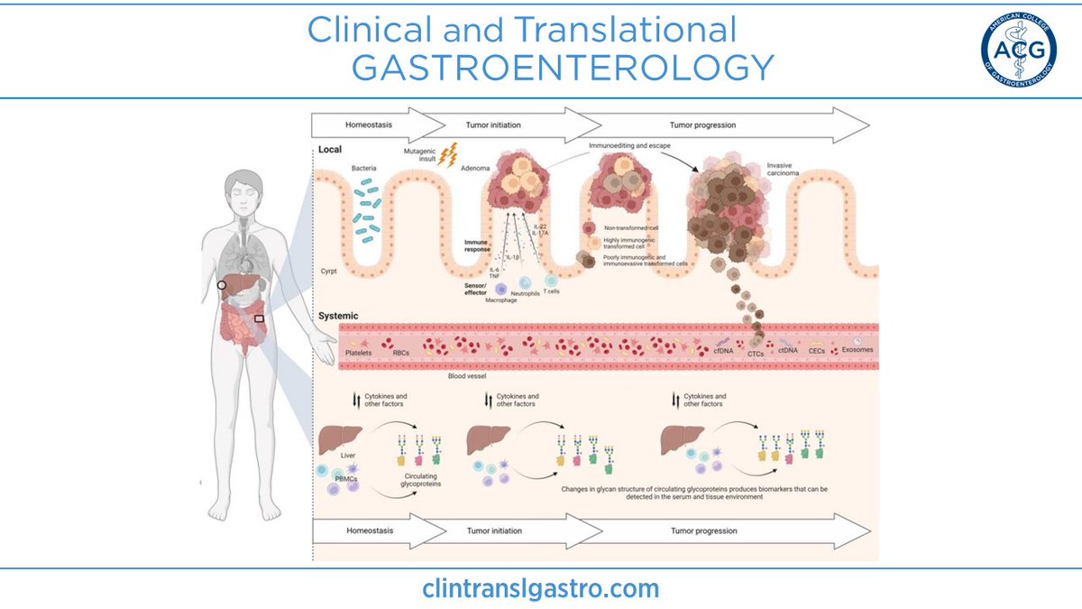 ACG_CTG (@acg_ctg) on Twitter photo In #CTGjournal:
Warning Signs from the Crypt: Aberrant Protein Glycosylation Marks Opportunities for Early Colorectal Cancer Detection
Chandrasekar, et al.
➡️ bit.ly/3OGz20n
<a href="/AmCollegeGastro/">ACG</a> <a href="/brianjacobsonmd/">Brian Jacobson</a> <a href="/LevinthalDavid/">David J. Levinthal, MD, PhD</a> <a href="/PopovVioleta/">Violeta Popov, MD PhD</a> <a href="/EugeniaShmidtMD/">Eugenia Shmidt MD</a> <a href="/Chirag1991/">Chirag Dhar, MD., MAS., F.A.P.C.R.</a> In #CTGjournal:
Warning Signs from the Crypt: Aberrant Protein Glycosylation Marks Opportunities for Early Colorectal Cancer Detection
Chandrasekar, et al.
➡️ bit.ly/3OGz20n
<a href="/AmCollegeGastro/">ACG</a> <a href="/brianjacobsonmd/">Brian Jacobson</a> <a href="/LevinthalDavid/">David J. Levinthal, MD, PhD</a> <a href="/PopovVioleta/">Violeta Popov, MD PhD</a> <a href="/EugeniaShmidtMD/">Eugenia Shmidt MD</a> <a href="/Chirag1991/">Chirag Dhar, MD., MAS., F.A.P.C.R.</a>