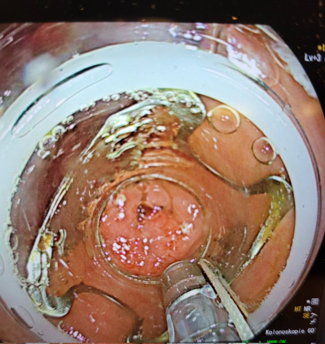 ThomasBalanis's tweet photo. Referral for a non-lifting polyp with high-grade-dysplasia in colon descendens. Full-thickness-resektion with #FTRD #Ovesco done. pT1 adenocarcinoma, R0 Resection. #GITwitter @AEMLondon @KMonkemuller https://t.co/Yqv2OIrsDT