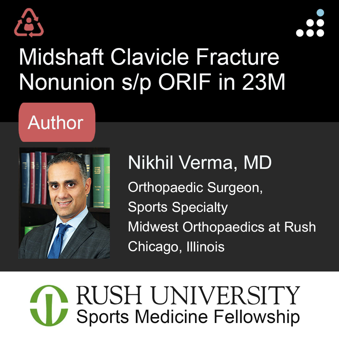 orthobullets's tweet photo. Here are intra-op & post-op images of yesterday's case by Dr. Nikhil Verma (@DrNikhilVerma) and Midwest Orthopaedics at Rush (@MOR_Docs).
MIDSHAFT CLAVICLE FRACTURE NONUNION S/P ORIF IN 23M
Do you agree with the treatment? Why or why not?
Leave a comment and keep the great conversation going! #orthotwitter