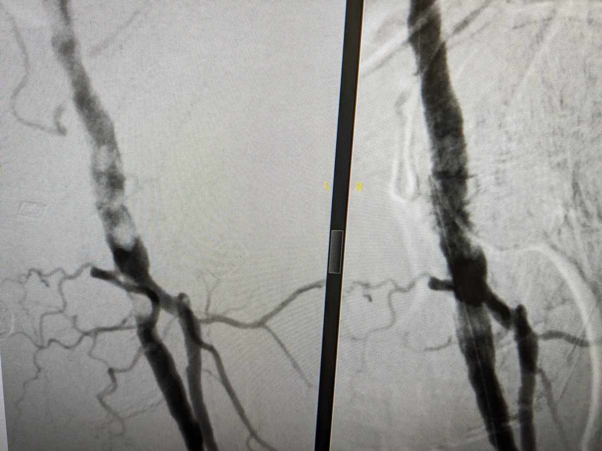 Badri (@badrivv) on Twitter photo Leaving nothing behind...CFA IVL using 7mm Shockwave catheter
<a href="/a_saratzis/">Athanasios Saratzis</a> <a href="/vascularIR/">Lorenzo Patrone</a> <a href="/BSETnews/">BSET</a> @K_Stavroulakis <a href="/MWF_1988/">Matthew Francis</a> <a href="/Suesteele84/">Sue Steele</a> Leaving nothing behind...CFA IVL using 7mm Shockwave catheter
<a href="/a_saratzis/">Athanasios Saratzis</a> <a href="/vascularIR/">Lorenzo Patrone</a> <a href="/BSETnews/">BSET</a> @K_Stavroulakis <a href="/MWF_1988/">Matthew Francis</a> <a href="/Suesteele84/">Sue Steele</a>