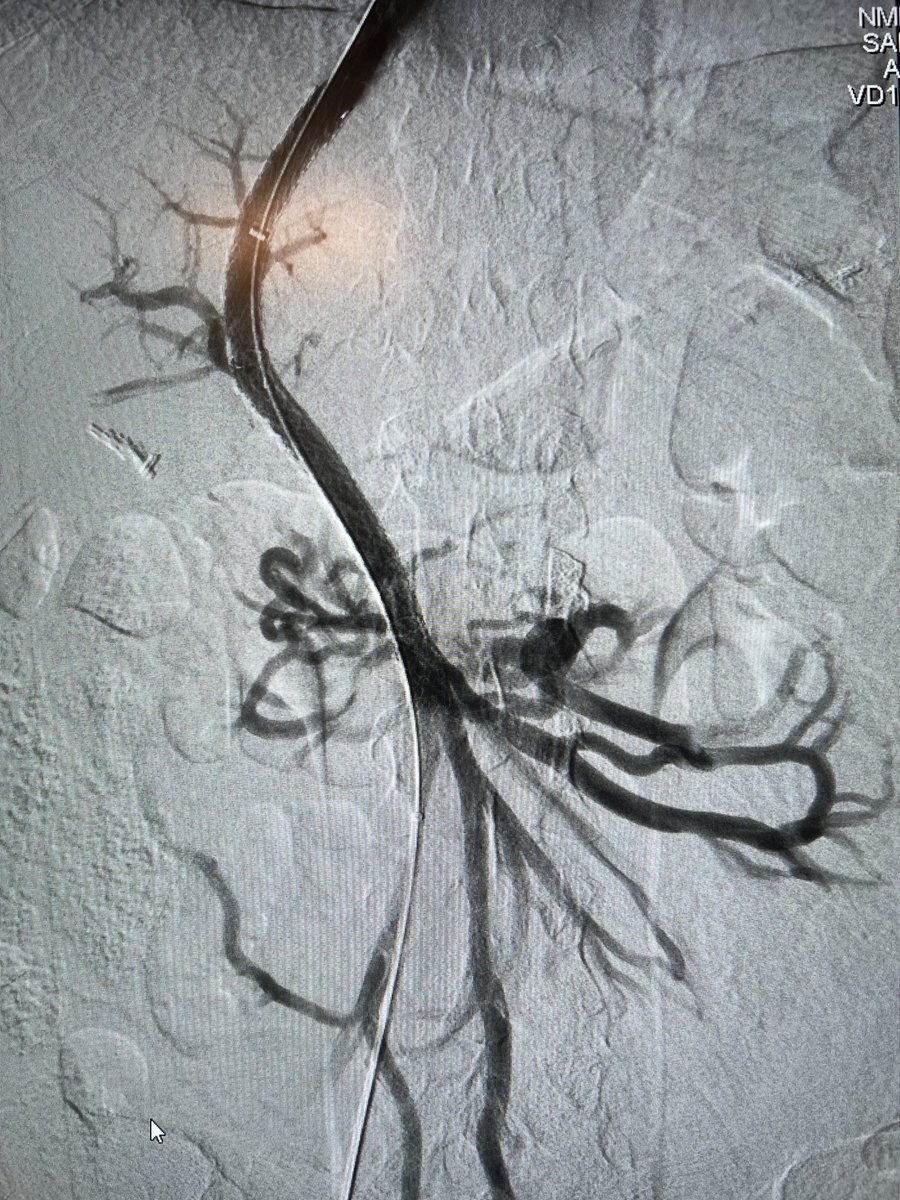 NorthwesternIR (@northwesternir) on Twitter photo ITP no spleen PHTN bleed. Non cirr. PV always there even not on seen CT. Use SMV to see it. TIPS “almost” never impossible. <a href="/SIRspecialists/">Society of Interventional Radiology</a> <a href="/cirsesociety/">CIRSE</a> <a href="/AASLDtweets/">AASLD</a> <a href="/ASTSChimera/">ASTS</a> <a href="/NURadiology/">Northwestern Radiology</a> <a href="/EASLnews/">EASLnews</a> <a href="/riadsalemIR/">Riad Salem</a> ITP no spleen PHTN bleed. Non cirr. PV always there even not on seen CT. Use SMV to see it. TIPS “almost” never impossible. <a href="/SIRspecialists/">Society of Interventional Radiology</a> <a href="/cirsesociety/">CIRSE</a> <a href="/AASLDtweets/">AASLD</a> <a href="/ASTSChimera/">ASTS</a> <a href="/NURadiology/">Northwestern Radiology</a> <a href="/EASLnews/">EASLnews</a> <a href="/riadsalemIR/">Riad Salem</a>