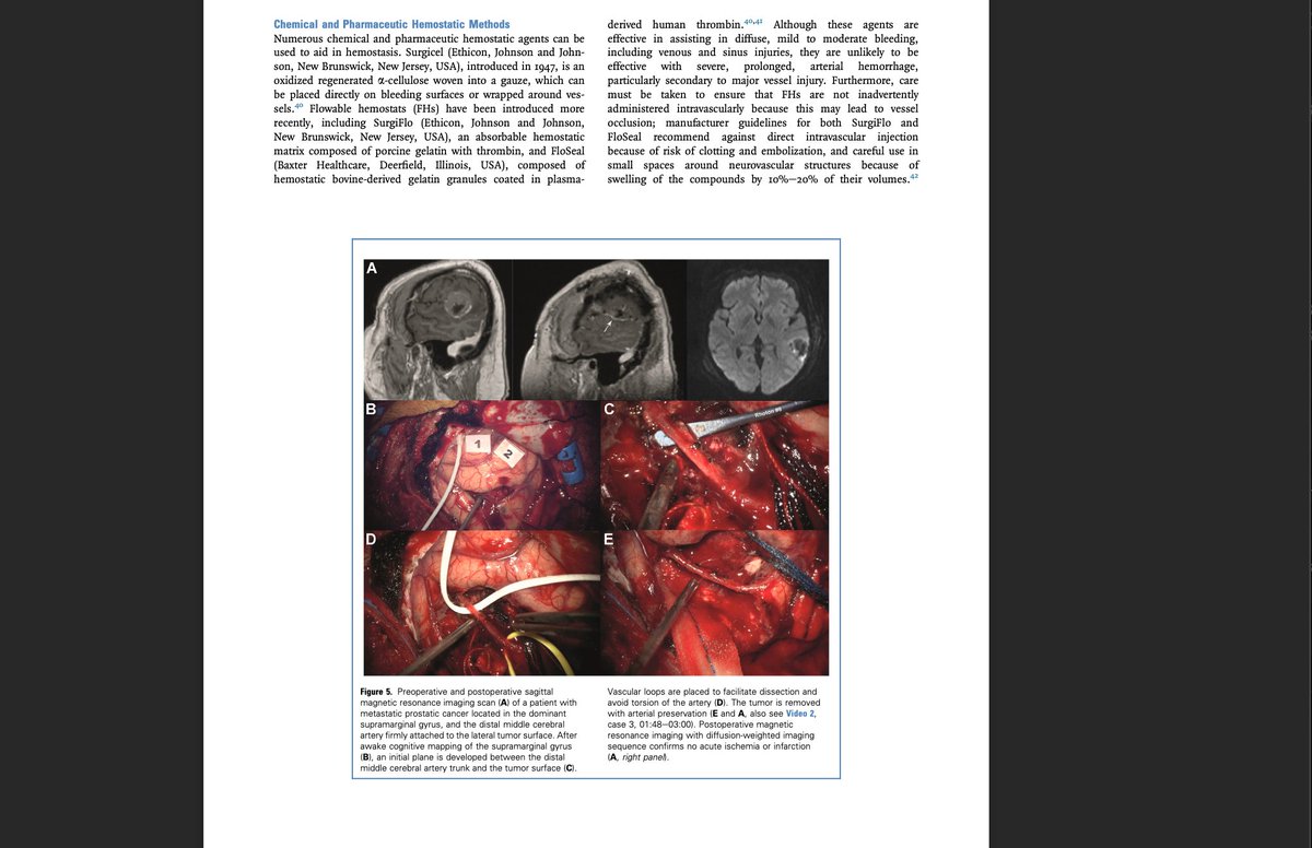 George Samandouras (@gsamandouras) on Twitter photo Have you encountered torrential haemorrhage during brain tumour surgery? Did you need to preserve critical arteries while removing the tumour? This article, with many superb video examples, will be of help. pubmed.ncbi.nlm.nih.gov/37178915/ <a href="/trainthebest/">Masters of Neurosurgery</a> <a href="/QS_SimCentre/">Queen Square Simulation Centre</a> <a href="/mtlawton/">Michael T. Lawton, MD</a> <a href="/e1v1m1/">BNTA</a> Have you encountered torrential haemorrhage during brain tumour surgery? Did you need to preserve critical arteries while removing the tumour? This article, with many superb video examples, will be of help. pubmed.ncbi.nlm.nih.gov/37178915/ <a href="/trainthebest/">Masters of Neurosurgery</a> <a href="/QS_SimCentre/">Queen Square Simulation Centre</a> <a href="/mtlawton/">Michael T. Lawton, MD</a> <a href="/e1v1m1/">BNTA</a>