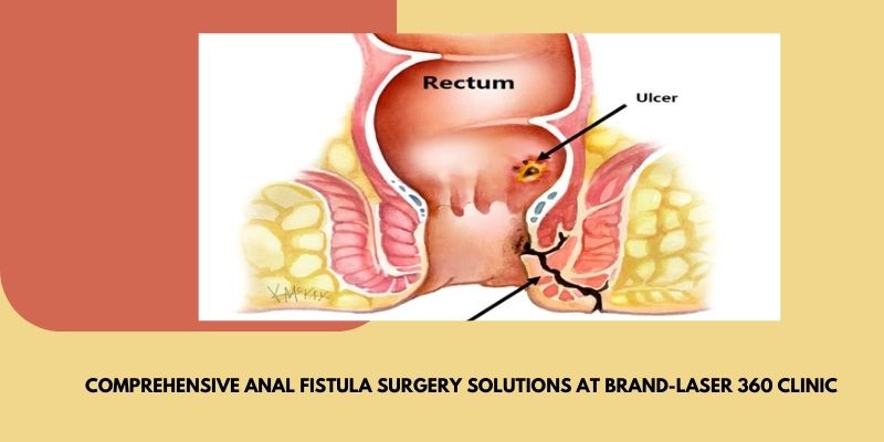 Seek effective anal fistula surgery at Brand-Laser 360 Clinic. #analfistulasurgery
#fistulasurgery
#lasertreatmentoffistula
laser360clinic.com/laser-fistula-…