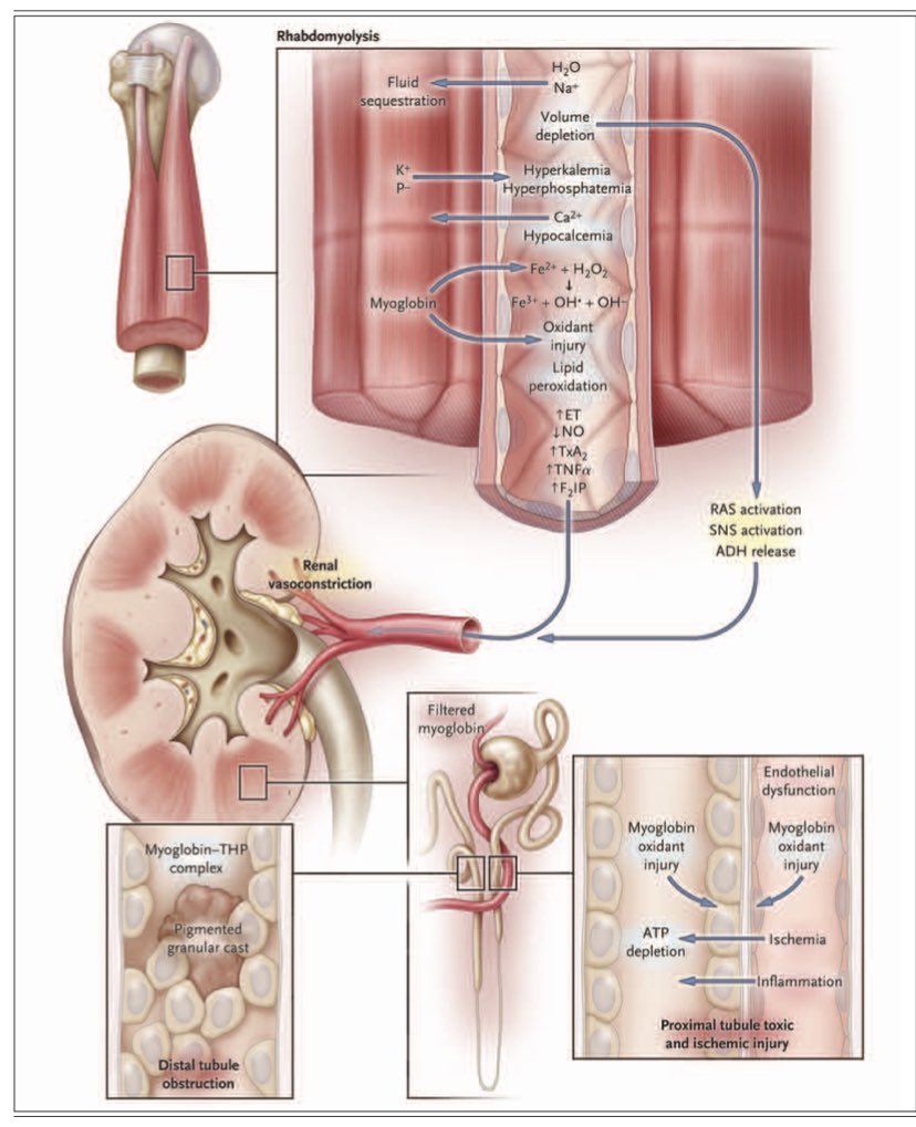 DailyUrgencias's tweet photo. 📍 Rabdomiolisis 

📌McMahon Score 
📌Cristaloides 💦 iniciar 400 ml/hr terapia dirigida a objetivos uresis de 1 ml/kg/hr a 3 ml/kg/hr
📌NO furosemide ya que empeora la obstrucción tubular distal
📌 Manitol no hay evidencia fuerte

🔗Descarga en telegram: https://t.co/oTKggL6KC4 https://t.co/f9PMrCPE84