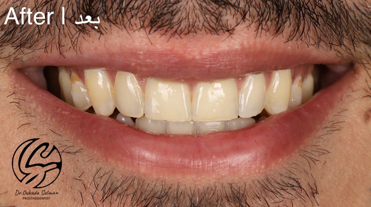 OubaDontist's tweet photo. حالة جميلة تم عمل فيها تجميل لسن واحد فقط و برغم بساطتها الا انها مليئة بالتحديات ،  اولا محاكاة لون سن واحد مع باقي الاسنان 
ثانيا المراجع طبيب أسنان متخصص
ثالثا و هي الأصعب انه صديق الدرب ووجهي بوجهه 24 ساعة 😅 @Hassan_HRA https://t.co/dyTg6CHS8v