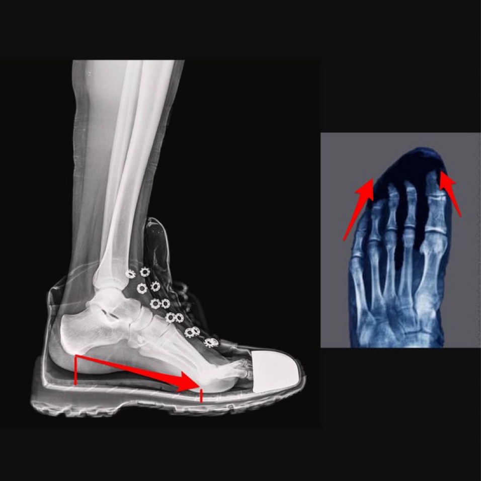 Austin Keith 🦶🏼 on Twitter "Traditional shoes restrict the natural movement of your feet They