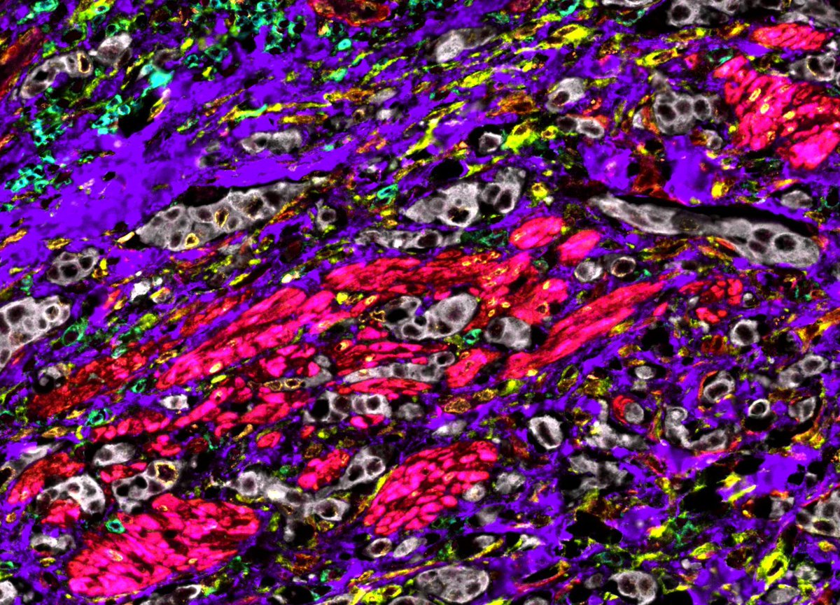 Dalia has profiled 100s of primary resected tumors +/- neoadjuvant therapy and metastatic tumors, including those collected from patients on our trial, with her 12-marker panel. Exciting to test hypotheses about vitamin D activity on fibroblasts in paired human specimens.