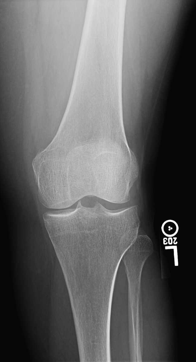 Happy Friday!   

Case 133: Tall man, in his 20s, with hip and knee pain. 
Diagnosis? 

Answer will be posted next Friday, 6/30.  

#MSKRad #RadRes #RadFellows #MedTwitter #Radiology