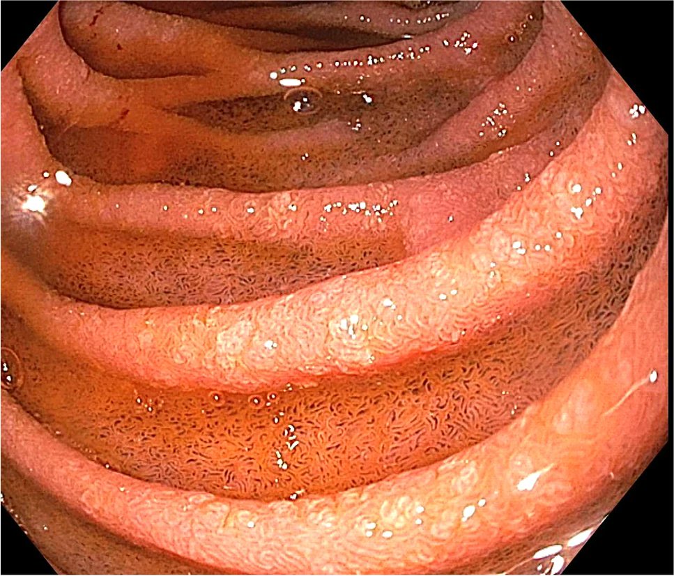 40 F undergoing endoscopy for variceal screening. 
screening
Guess the diagnosis?

For answers, see here link.springer.com/article/10.100…
#IJG
#ImagesinClinicalGastroenterology