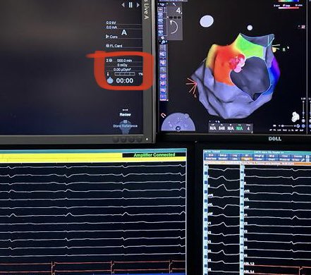 45 M, NICMP, LVEF %35, ICD implanted 1 year ago. He had %30 PVC burden and frequent nsVT. All PVC and nsVT terminated by applying RF on the posterior mitral annulus. I plan to extract his ICD if his LVEF increases to normal values. Does anyone disaggree with me? # Zerofluoro