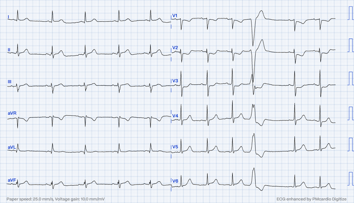 Does this #ECG of a 75yo male presenting with chest pressure concern you?

No risk factors and initial hs-cTnT is just barely positive.

#FOAMed #CardioTwitter
