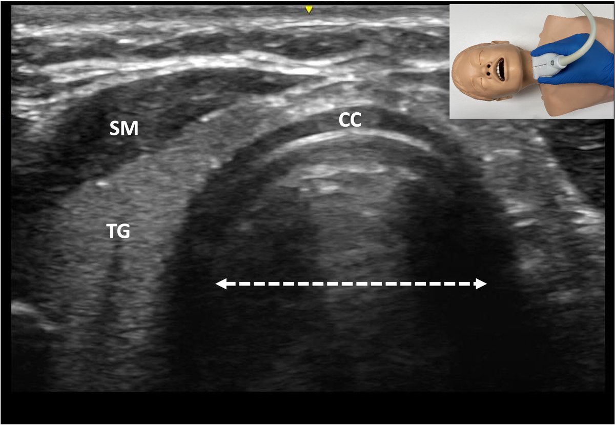 Our recent scoping review of Ultrasonographic Techniques in the Evaluation of the Pediatric Airway. Congrats to Dr. Burton for his excellent work on the paper. 

onlinelibrary.wiley.com/doi/10.1002/ju…