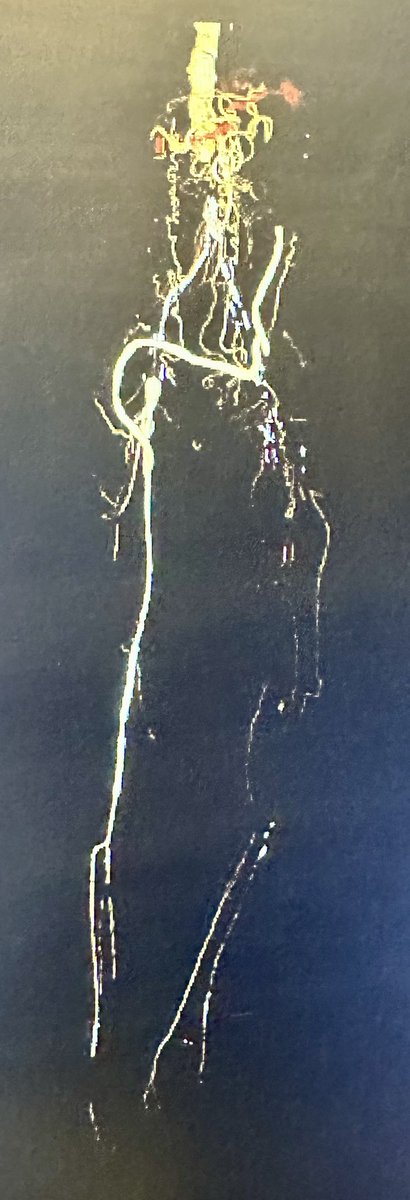 jcgeorgemd's tweet image. #ComplexCase Friday at #PennsyInterventions:  71 yo male placed in hospice care after multiple failed surgical bypass procedures, now presenting for limb salvage after rescinding hospice due to progressive rest pain and worsening ulceration and dry gangrene in L foot.