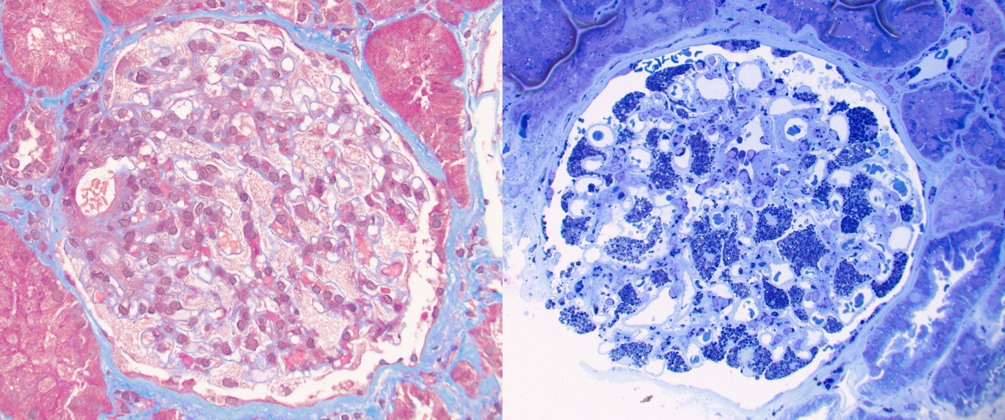 Jean Hou, MD on Twitter "Fabry Friday Surprise in a young male with proteinuria. Lipid