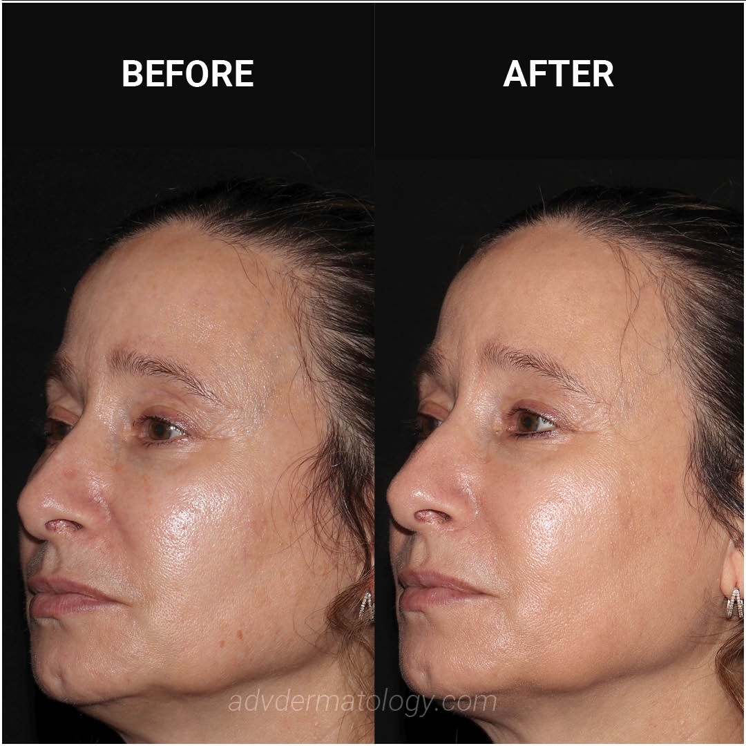 Emface® is a cutting-edge procedure that combines synchronized RF and HIFESTM energies, working simultaneously on both the skin and muscles. This unique approach results in fewer wrinkles and a natural lift, all without the need for needles. 💫💉

advdermatology.com/request-appoin…