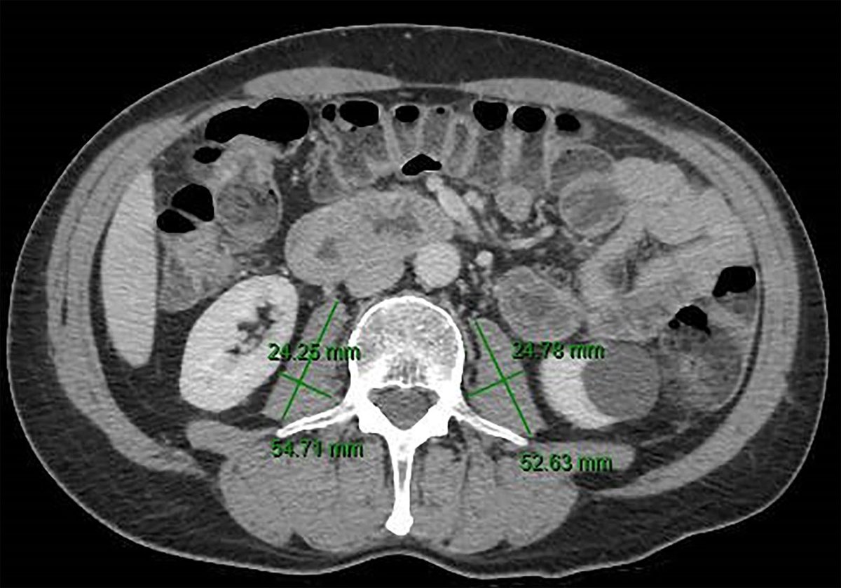 DCRjournal (@dcrjournal) on Twitter photo Sarcopenia NOT a predictor of poor response to neoadjuvant therapy in pts with locally advanced rectal cancer. Read more in this month's #DCRJournal #rectalcancer issue.  
<a href="/bedrikovetski/">Sergei Bedrikovetski</a> <a href="/tarik_sammour/">Tarik Sammour</a> <a href="/UniofAdelaide/">Uni of Adelaide</a> <a href="/CentralAdlLHN/">Central Adelaide</a> @Swexner <a href="/me4_so/">SoMe4Surgery</a> <a href="/ACPGBI/">@ACPGBI</a> <a href="/drtracyhull/">Tracy Hull</a> <a href="/ASCRS_1/">ASCRS_1</a> Sarcopenia NOT a predictor of poor response to neoadjuvant therapy in pts with locally advanced rectal cancer. Read more in this month's #DCRJournal #rectalcancer issue.  
<a href="/bedrikovetski/">Sergei Bedrikovetski</a> <a href="/tarik_sammour/">Tarik Sammour</a> <a href="/UniofAdelaide/">Uni of Adelaide</a> <a href="/CentralAdlLHN/">Central Adelaide</a> @Swexner <a href="/me4_so/">SoMe4Surgery</a> <a href="/ACPGBI/">@ACPGBI</a> <a href="/drtracyhull/">Tracy Hull</a> <a href="/ASCRS_1/">ASCRS_1</a>