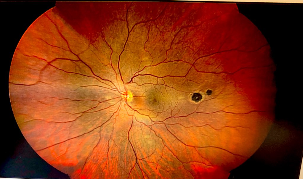 #EyeTumorOfTheDay

Los tumores intraoculares pueden ser silenciosos, y a veces malignos. 

Un diagnóstico temprano mediante un examen ocular dilatado es vital. 

Las fotos del fondo de ojo y la ecografía ocular son herramientas poderosas para la detección. 💪

Recuerda: Tu visión…