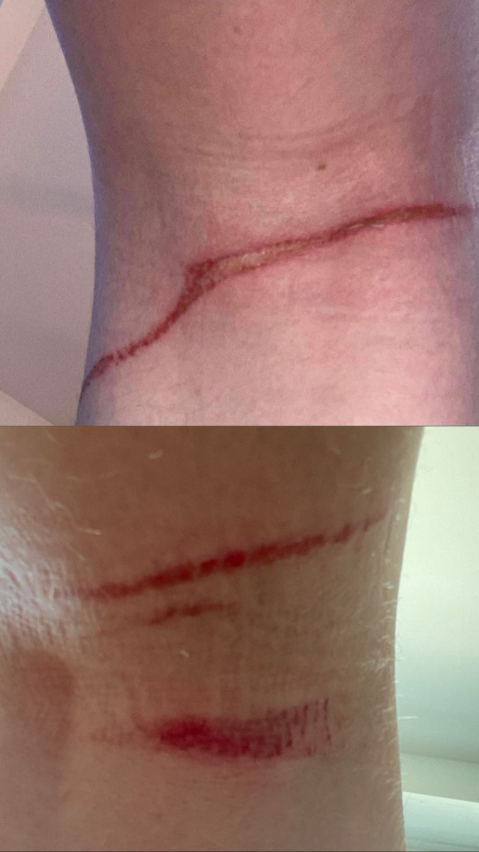 EDanslos's tweet image. The art VS the artist
(Oui, c’est l’arrière de mes genoux donc cette merde de laisse m’a bien brûlé sur 10cm par jambe)