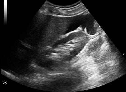 The Trauma lead is happy to do a fast scan. What would indicate a positive fast scan? 
And what would be the next step? 

#mafridays #SoMe4Trauma