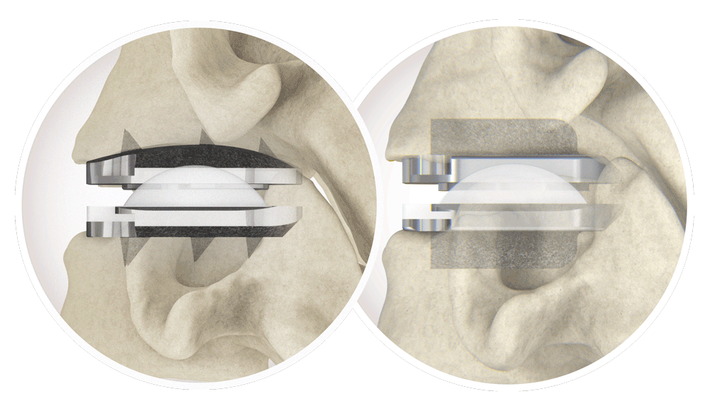 CentinelSpine's tweet photo. Learn why Robin Young of @Ryortho1 said, “20 years ago, prodisc® was just one of a dozen motion preserving implants. Today, it is the clear #1.” Read more at https://t.co/j6aJPcC9aq.
#rediscover #centinelspine #prodisc #totaldiscreplacement  #ryortho https://t.co/Oj5gm8tsqQ