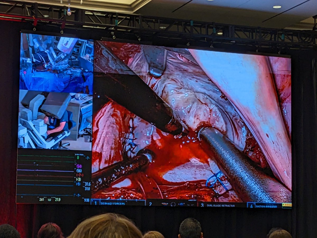 DavidSMolony's tweet photo. Personal highlight from @GaHeart_NGHS Symposium today was robotic mitral valve repair. Incredible https://t.co/9r8uEXbUUM