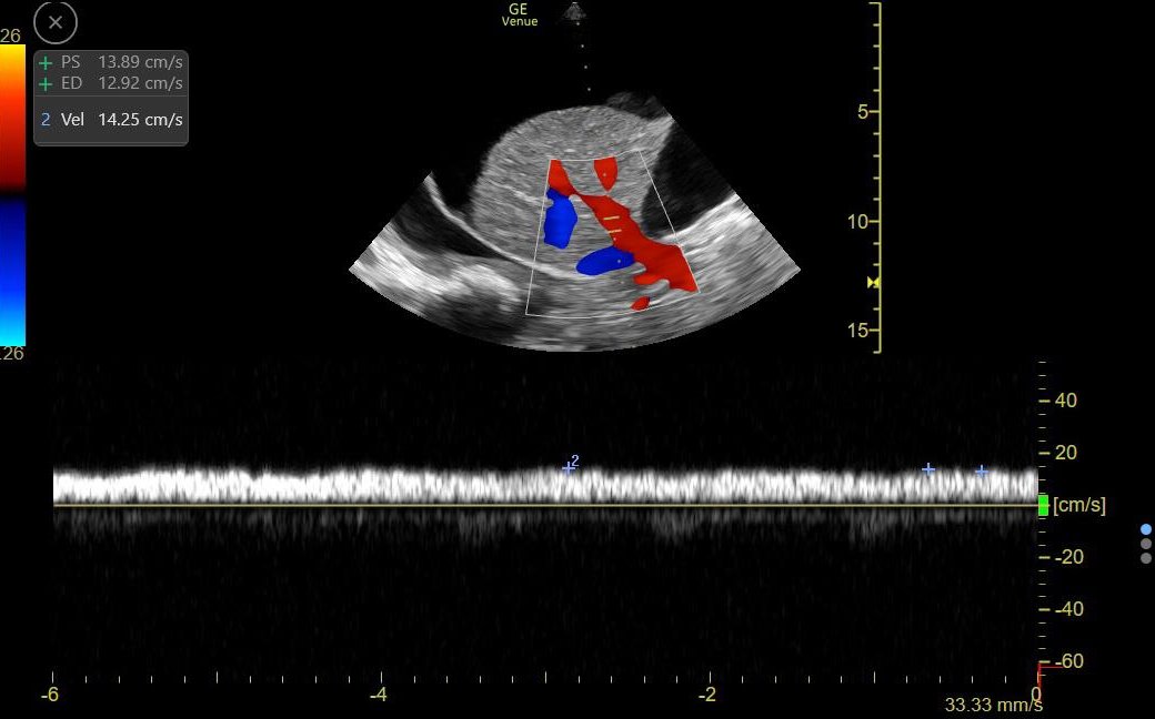 ArgaizR's tweet photo. #AKIConsultSeries 👵 with HFpEF ➡️ worsening dyspnea, hypoxemia and abdominal distension

Initially treated with IV Diuretics

🚨Developed Oliguria + Hypotension🚨 

#POCUS performed to evaluate residual congestion

https://t.co/Ar8q2rLioS 

1/3 https://t.co/mFvXodTsS4