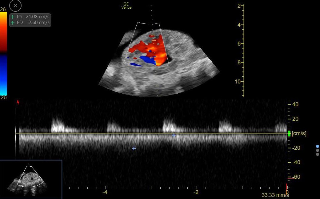 #AKIConsultSeries 👵 with HFpEF ➡️ worsening dyspnea, hypoxemia and abdominal distension

Initially treated with IV Diuretics

🚨Developed Oliguria + Hypotension🚨 

#POCUS performed to evaluate residual congestion

doi.org/10.1093/ehjcr/… 

1/3
