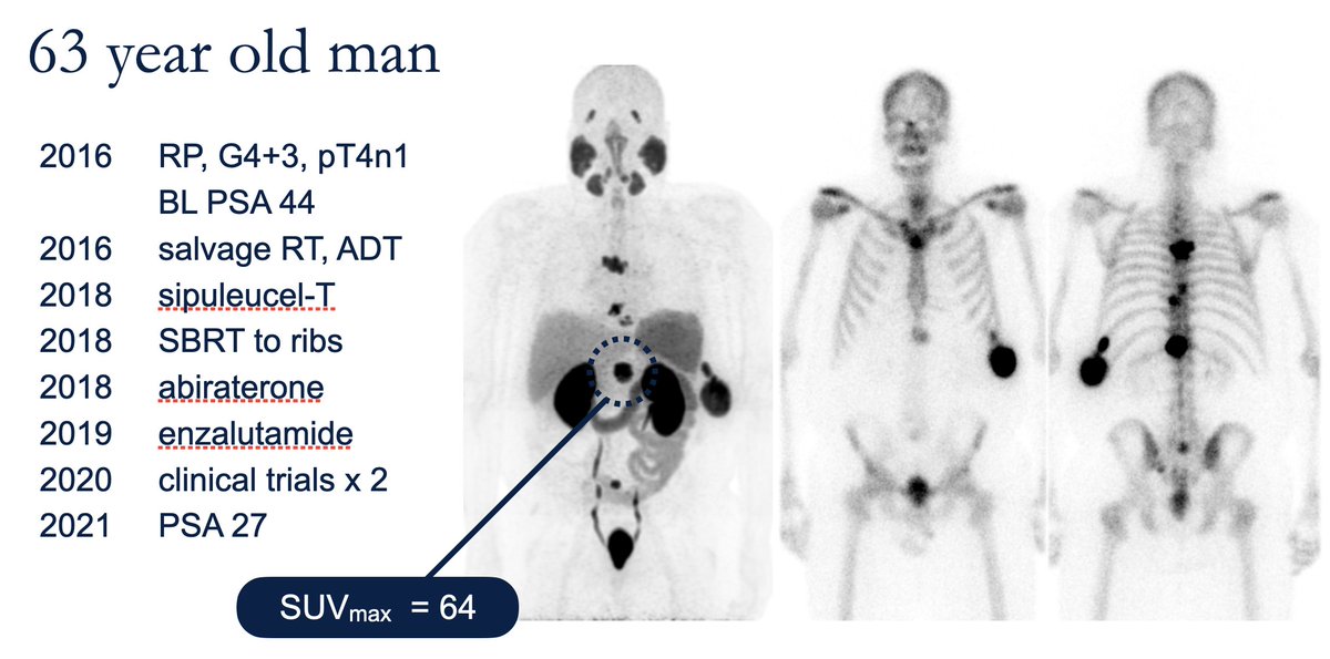 We will also have a tumor board focused on clinical applications of PSMA-targeted radioligand therapy. What an amazing panel including @morr316 @lisabodei @TubaKendi @CalaisJeremie. See what people think of cases like this. Looking forward to seeing everyone bright and early!