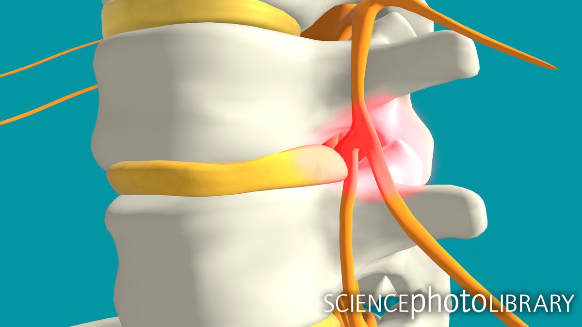 sciencephoto's tweet photo. Are you familiar with the term 'slipped disc'?
This illustration shows a close-up of a prolapsed disc, highlighting the pressure it can put on the surrounding tissue.
Credit: Tumeggy
https://t.co/yFhHmnVx31
#backpain #spinehealth #prolapseddisc #spinalhealthawareness https://t.co/uSNqmyEXCA