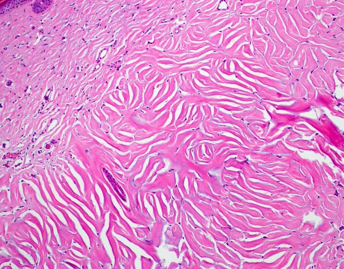 JMGardnerMD's tweet photo. 40 yo F solitary papule on neck.
More pics: https://t.co/5RGq8DppqC. If multiple lesions were present, what might that indicate? Answer &amp; video: https://t.co/szERwr7zMb #pathology #pathologists #pathTwitter #dermpath #dermatology #dermatologia #dermtwitter #BSTpath https://t.co/Ai6cTcJIdZ