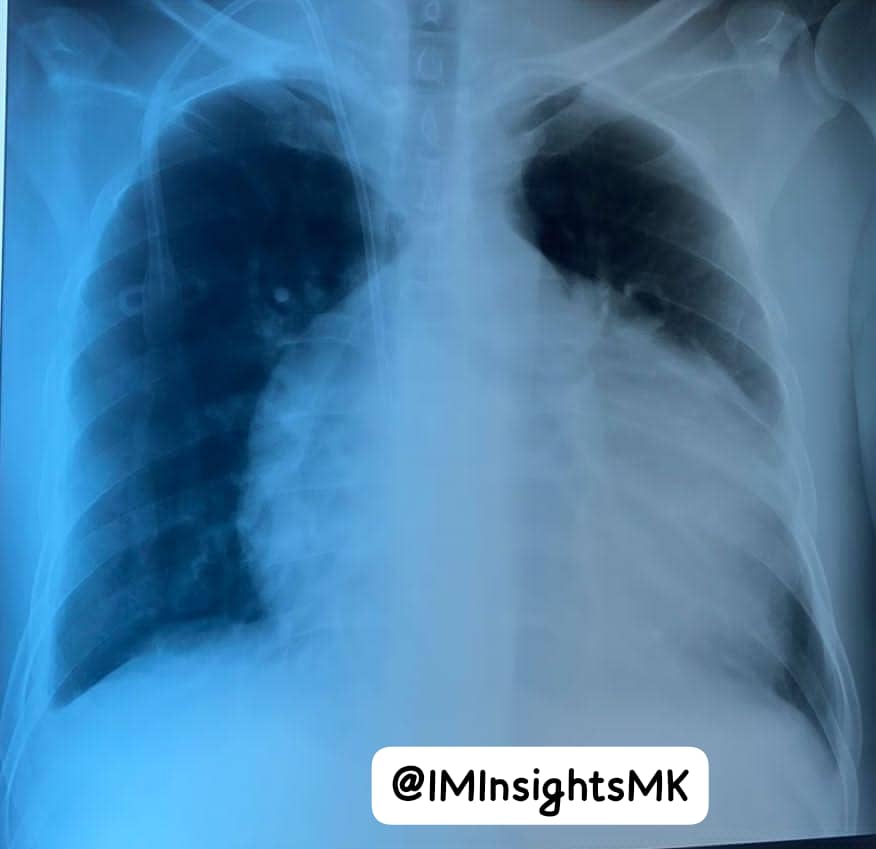 IMInsightsMK's tweet photo. 45/M.

T1DM, HTN, ESRD.

Irregular on HD.

C/O Breathlessness.

130/65 mmHg

Desaturating on RA.

Description?

DDx?

Initial workup?

@JosephOgavu 
@rkalyes1 
@DrOribaDan 
@dr_evenakato 
@graekan 
@DrOtileUg 
@atuhairwe_irene 
@NiravValand30 
@RoseMuhindo1 
@PeaceBagasha https://t.co/eqNcruoUGn