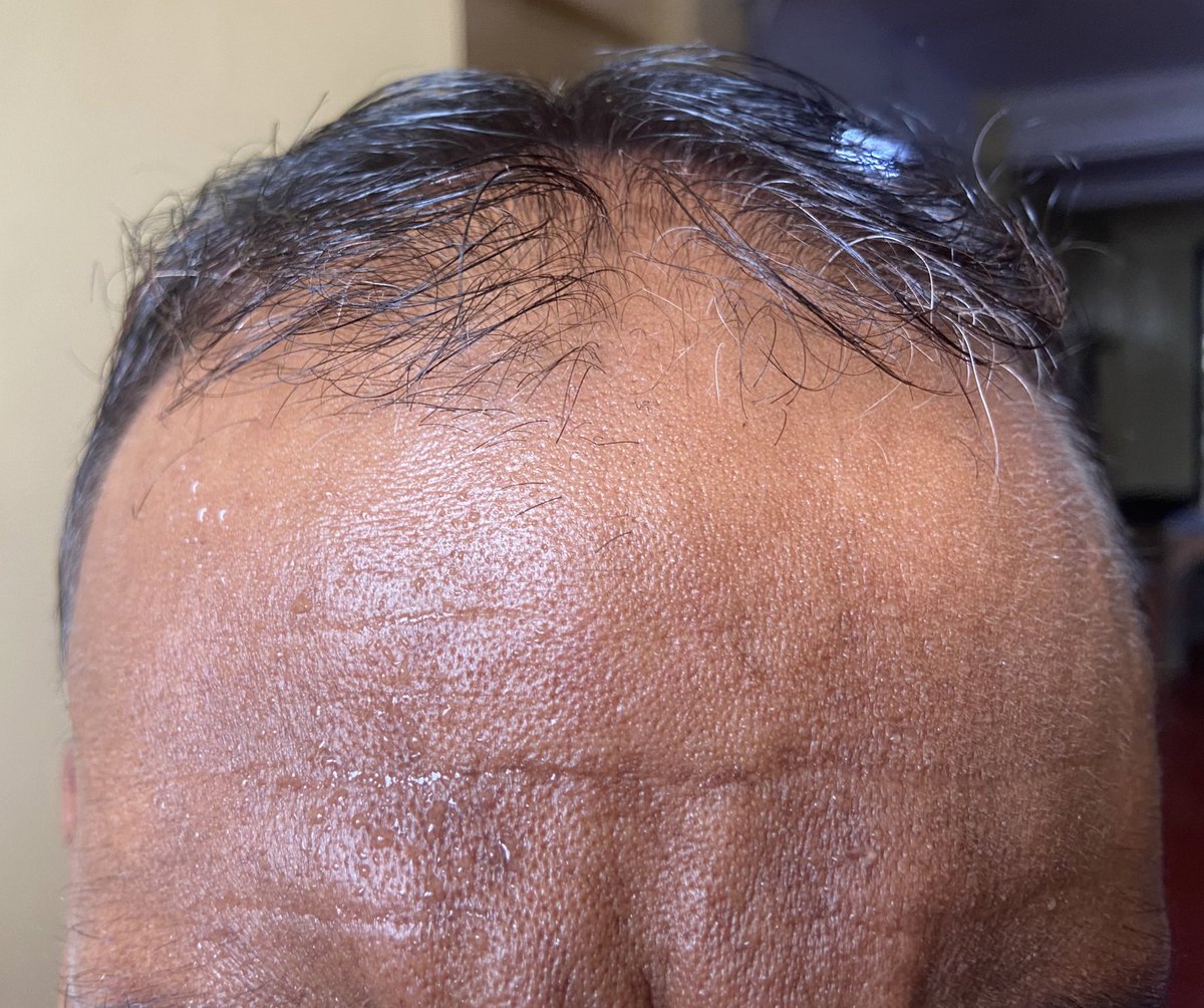 This is a very tough one! But #MedTwitter is smart enough!

What do you observe ?

Hint: 
In June, everyday it rained 
In June, everyday it pained 

(Details to follow soon)