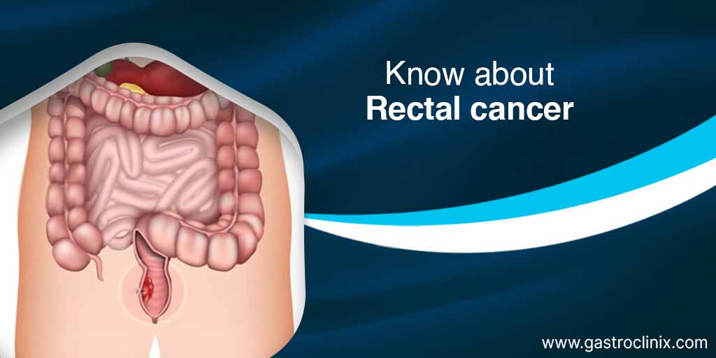 #Rectalcancer is a type of cancer that develops in the tissues of the rectum, which is the last part of the large intestine before the anus. Visit: gastroclinix.com/rectal-cancer/.
Dr. Harsh Shah is the premier rectal cancer specialist in Ahmedabad. Call for appointment: +916355564601.