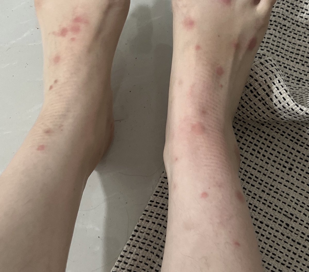 najihahshahrel's tweet photo. My house was infested by kutu kucing because of the new cat (im still pissed because none of the vets mentioned that he has kutu masa checkup).

RIP my leg sebab kutu gigit banyak gila pastu allergic reaction. Habis berparut juga 🤢 

Puas hati semua bug mampus!! https://t.co/qFPWlbScJj