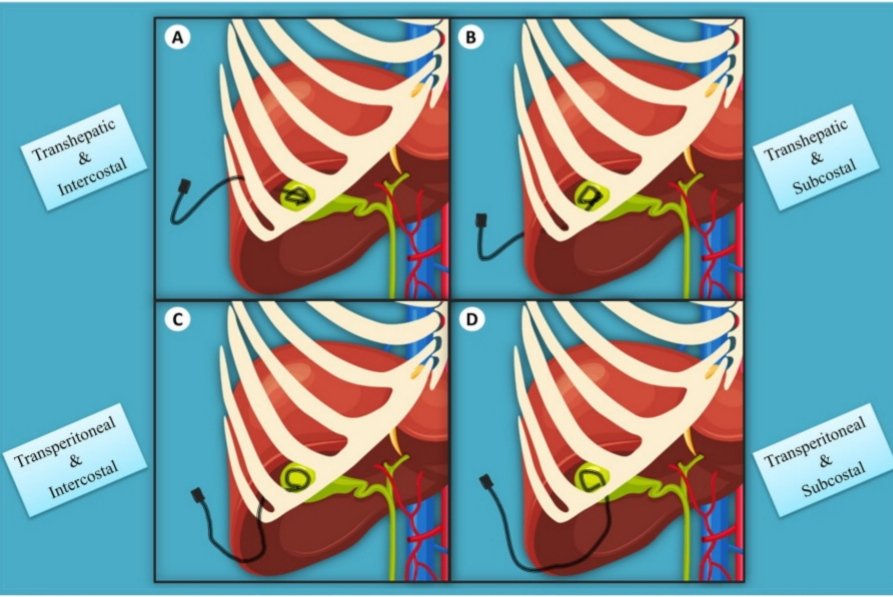 NAArkoudis's tweet photo. Excited to share our most recent article on "Percutaneous Cholecystostomy" which was just published in @SocietyAbdRad !

Full-text view-only version: https://t.co/wzY1I68nUd

https://t.co/FET8dqllNa 

#percutaneous #interventionalradiology #trocar #seldinger #cholecystostomy https://t.co/CHtX0dQuwQ