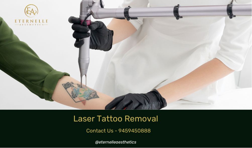 Laser Tattoo Removal | Versailles Medical Spa
