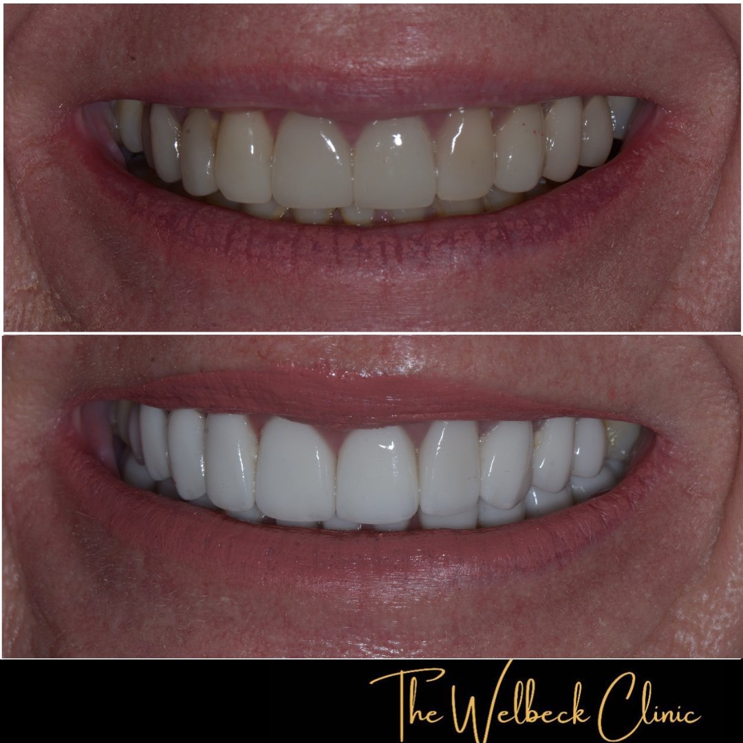 Dr Ilaty's patient was unhappy with veneers placed previously and wanted to change the shape and colour. 
10 upper and lower veneers were placed to achieve a brighter whiter smile.
To book a consultation contact us on 0207 486 8100
#veneers #teeth #smile #smilemakeover #dentist