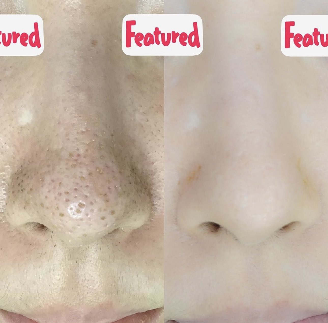 ダーマペン CLRローション15ml×2個 ダーマペン社公認「CLRローション